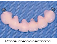 Prótese Fixa